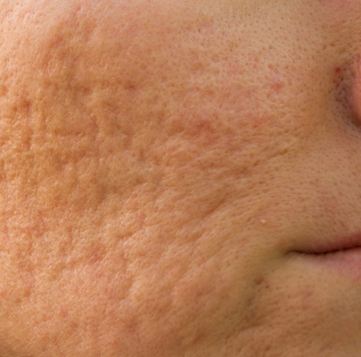 Closeup of face of female with acne scars | Acne Scars In Needham, MA | Wave Medical Aesthetics