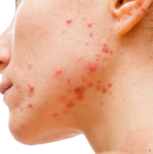Portrait of face of female with acne | Acne treatment in Needham, MA | Wave Medical Aesthetics