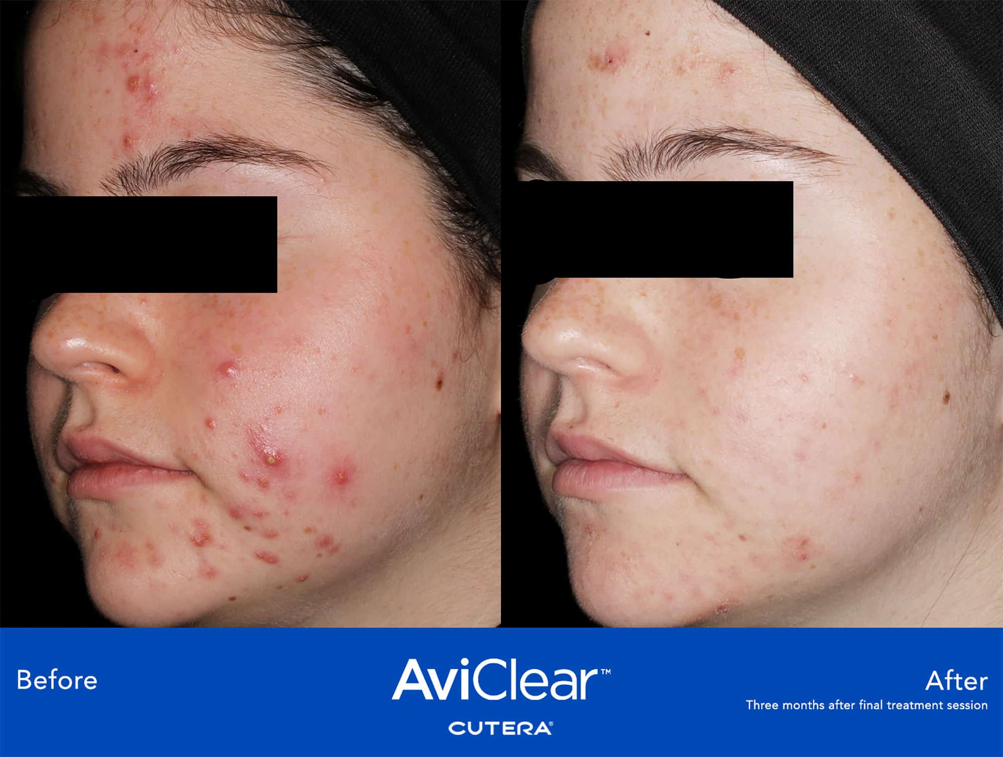 AviClear™ Cutera Acne Before & After treatment In Needham, MA | Wave Medical Aesthetics