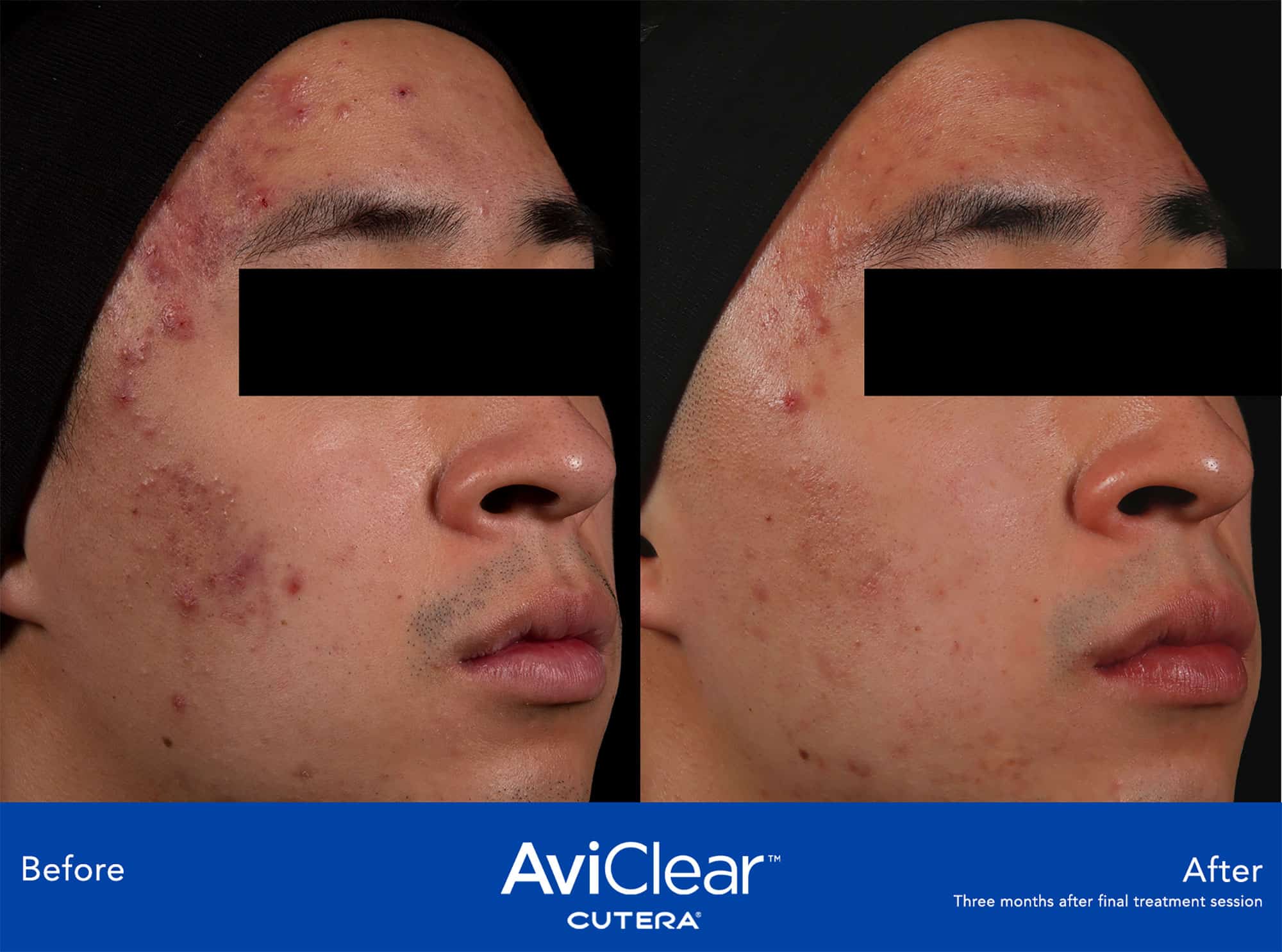 AviClear™ Cutera Acne Before & After treatment In Needham, MA | Wave Medical Aesthetics