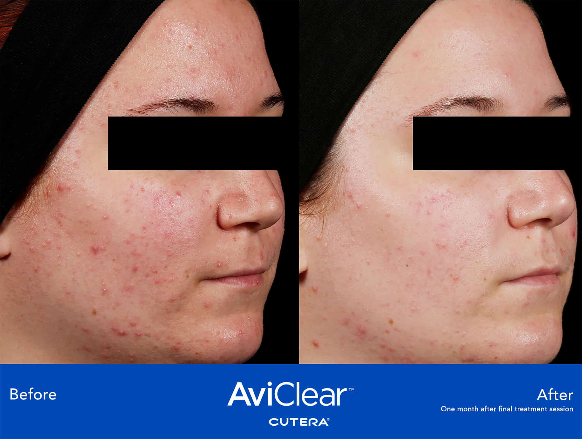 AviClear™ Cutera Acne Before & After treatment In Needham, MA | Wave Medical Aesthetics