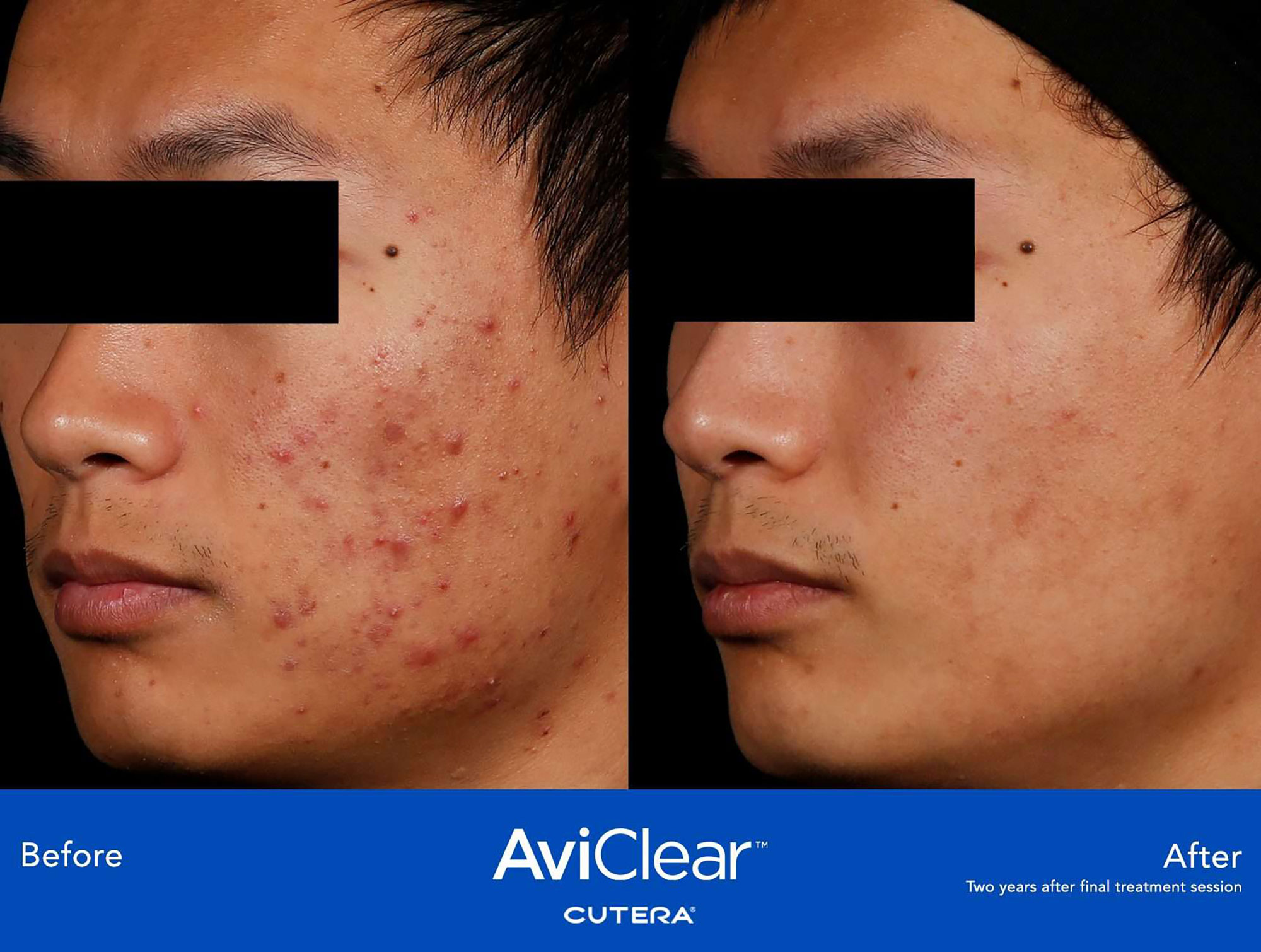 AviClear™ Cutera Acne Before & After treatment In Needham, MA | Wave Medical Aesthetics
