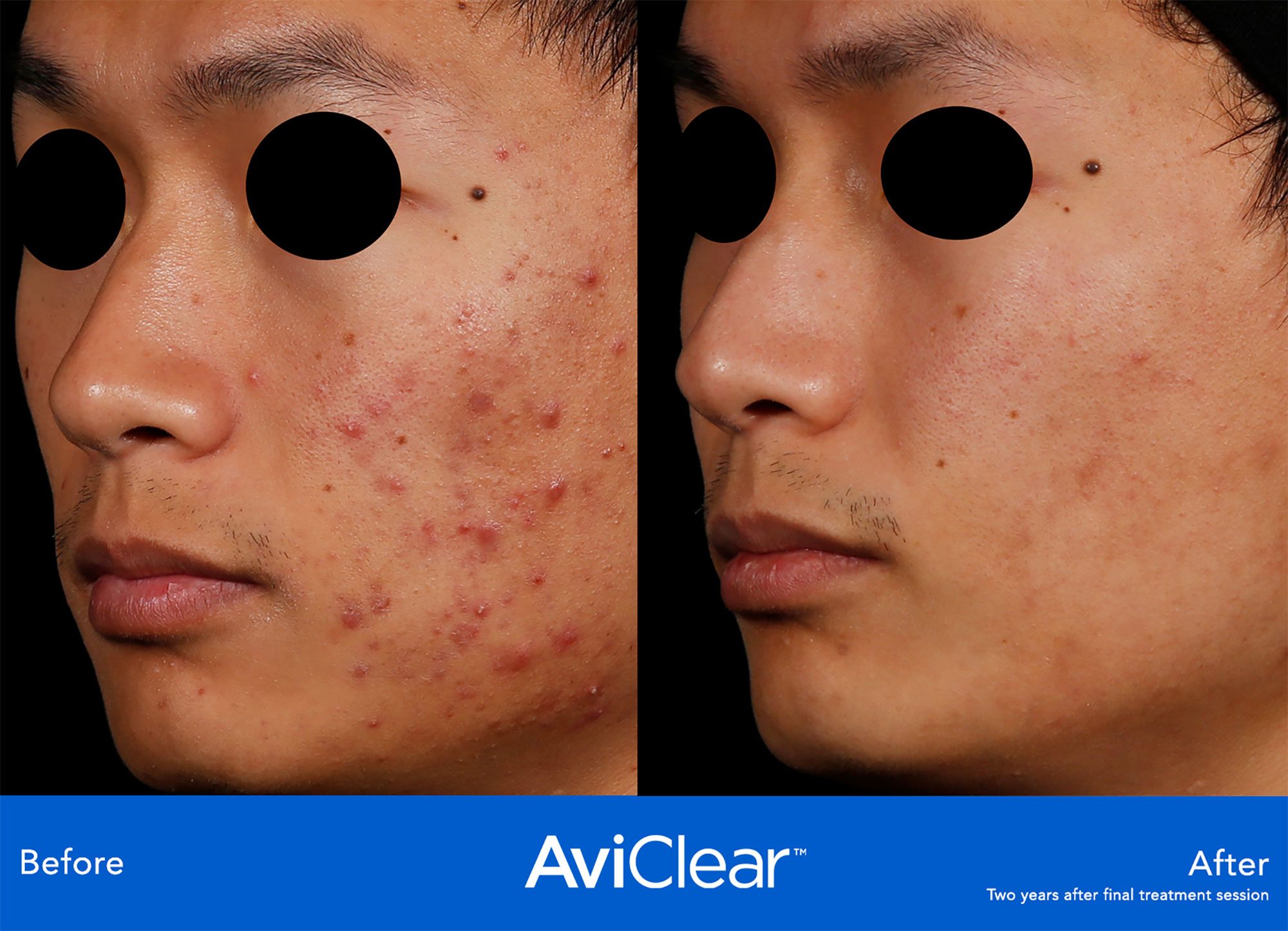 AviClear™ Cutera Acne Before & After treatment In Needham, MA | Wave Medical Aesthetics