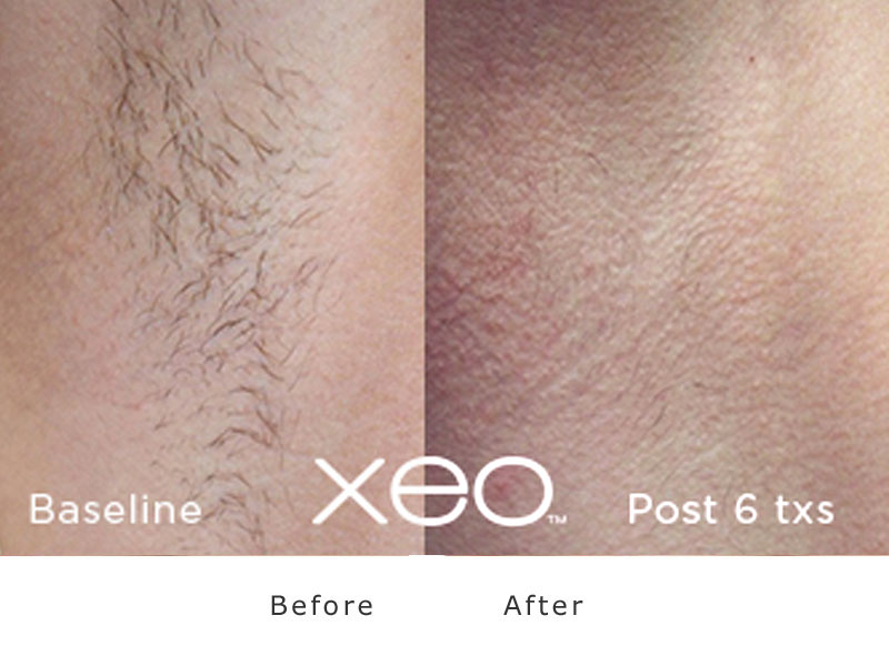 Laser Hair Removal Before & After XEO treatment In Needham, MA | Wave Medical Aesthetics