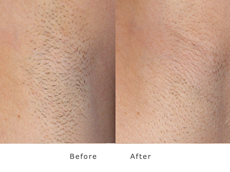 Laser Hair Removal Before & After XEO treatment In Needham, MA | Wave Medical Aesthetics