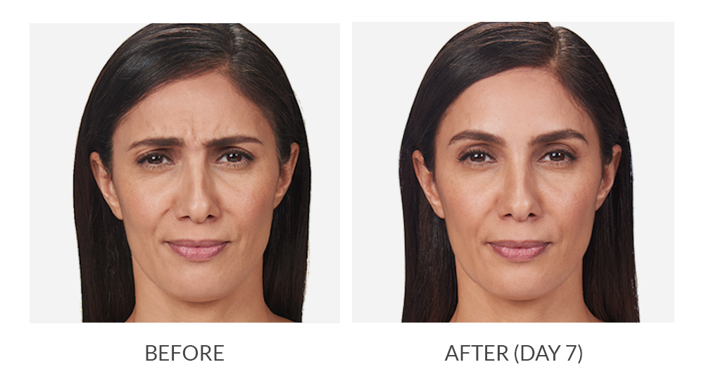 Neurotoxins Before & After treatment In Needham, MA | Wave Medical Aesthetics