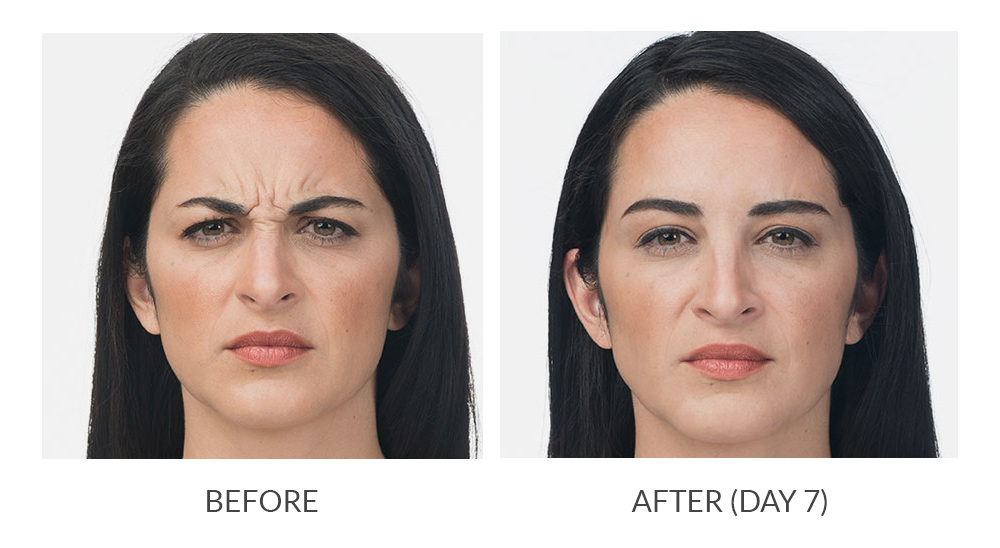 Neurotoxins Before & After treatment In Needham, MA | Wave Medical Aesthetics