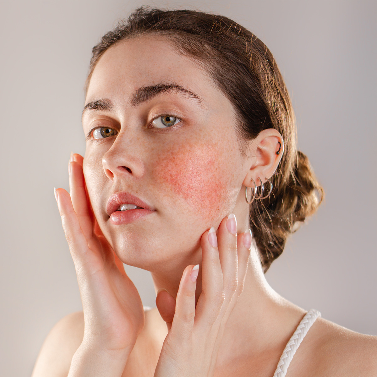 Portrait of a lady suffering from rosacea | Rosacea In Needham, MA | Wave Medical Aesthetics