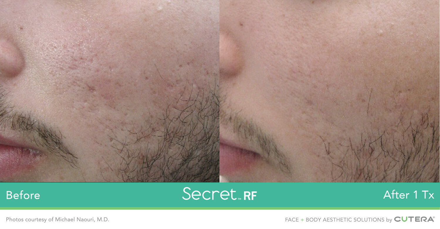 Secret RF Microneedling_Before & After_Images_wave-medical-aesthetics_in_Needham, MA_First