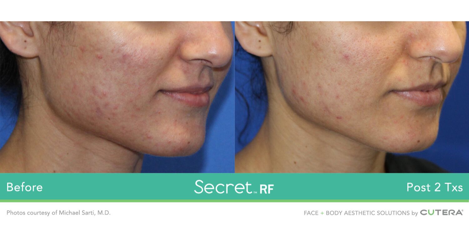 Secret RF Microneedling_Before & After_Images_wave-medical-aesthetics_in_Needham, MA_Fouth