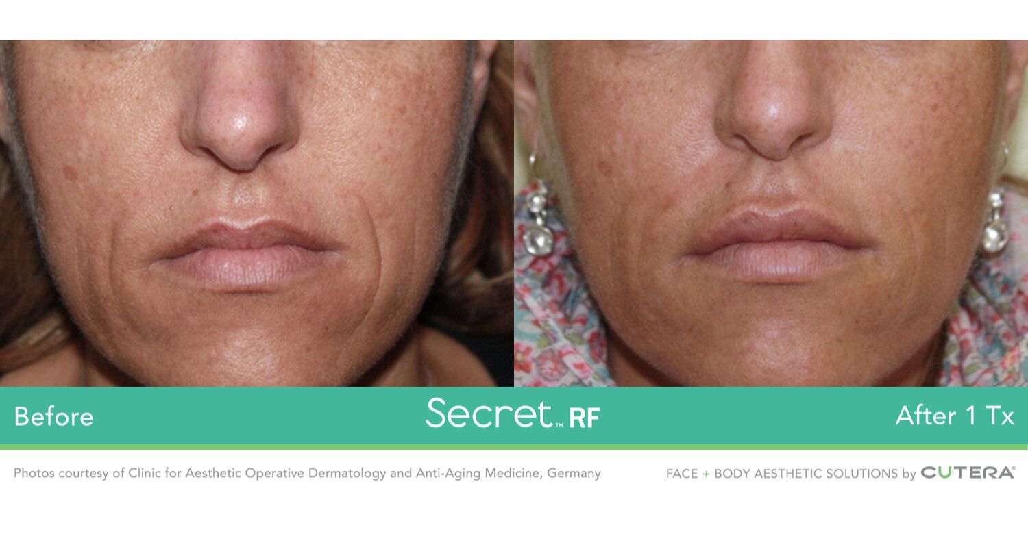 Secret RF Microneedling_Before & After_Images_wave-medical-aesthetics_in_Needham, MA_Second