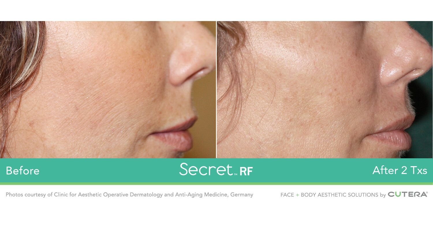 Secret RF Microneedling_Before & After_Images_wave-medical-aesthetics_in_Needham, MA_Third