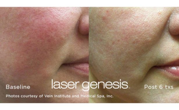 XEO Laser Genesis_Before & After_Images_wave-medical-aesthetics_in_Needham, MA_First