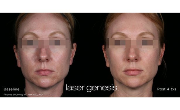 XEO Laser Genesis_Before & After_Images_wave-medical-aesthetics_in_Needham, MA_Fouth
