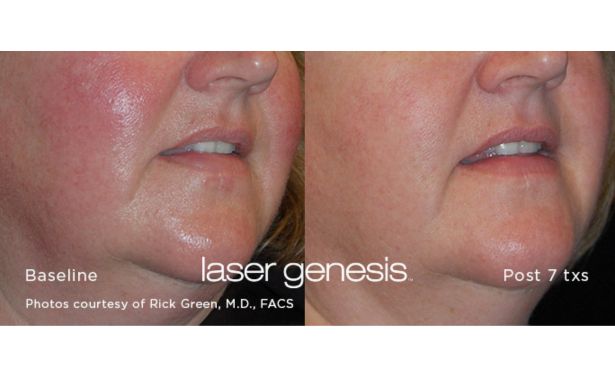 XEO Laser Genesis_Before & After_Images_wave-medical-aesthetics_in_Needham, MA_Second