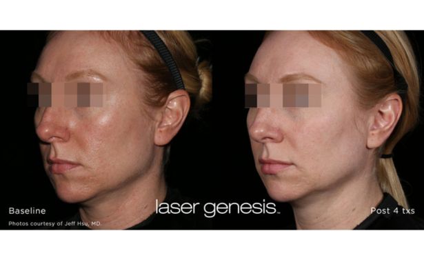 XEO Laser Genesis_Before & After_Images_wave-medical-aesthetics_in_Needham, MA_Third