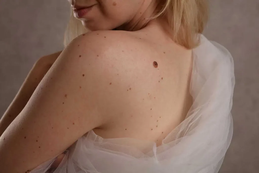 Skin Tags by Wave Medical Aesthetics in Needham MA