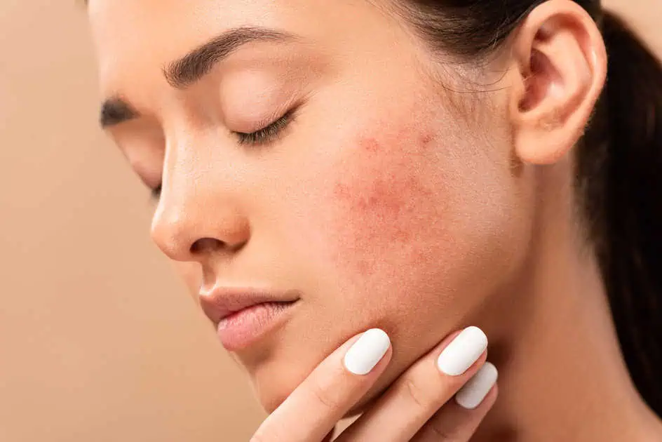 Acne by Wave Medical Aesthetics in Needham, MA