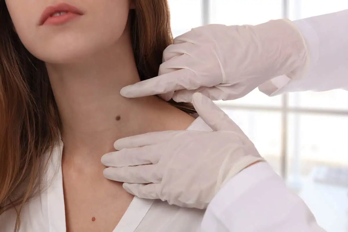 Skin Tag Removal by Wave Medical Aesthetics in Needham MA