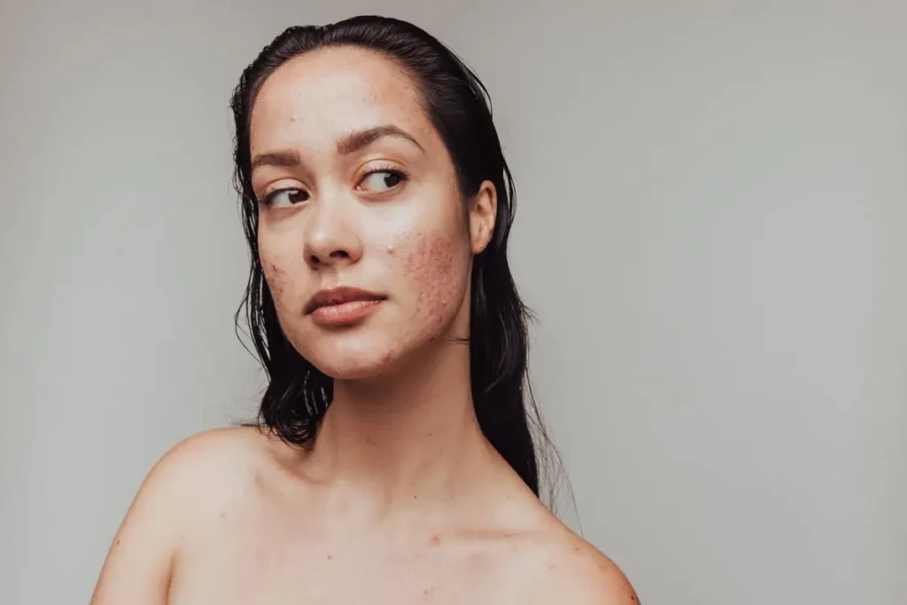 Woman with acne prone skin looking away VI Peel for Acne in Needham MA