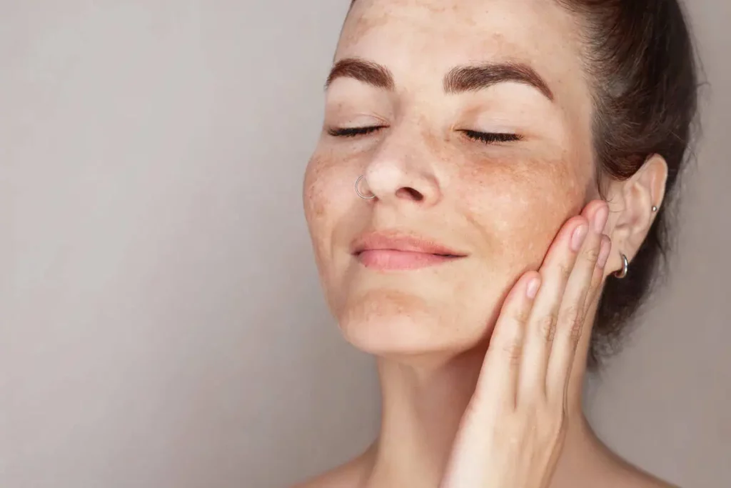 Woman with closed eyes touching face showing freckles and brown spots on skin