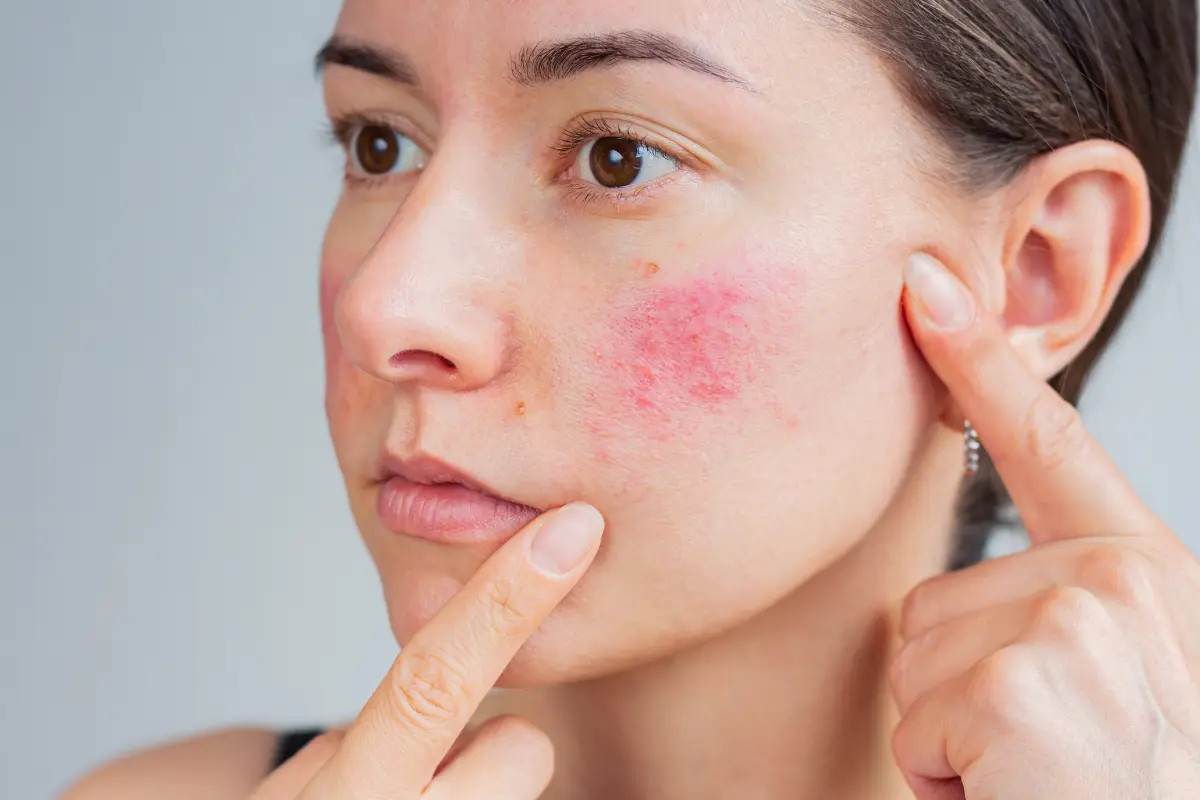 Woman pointing to red facial inflammation and acne scars in Needham, MA