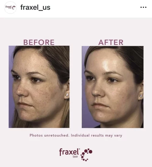 fraxel laser BA