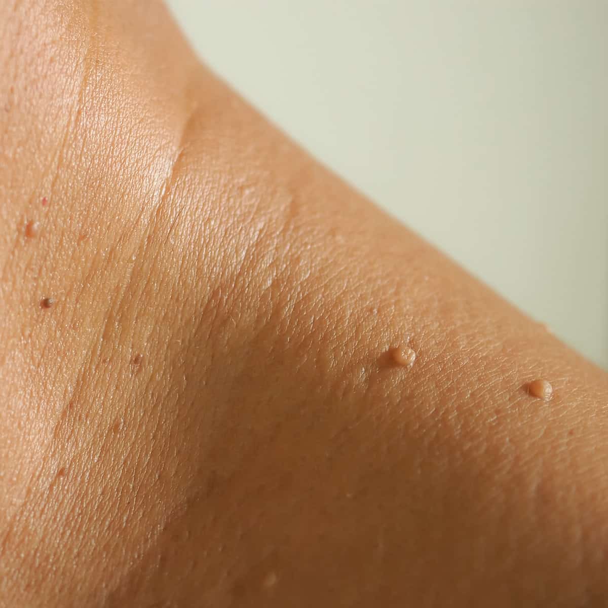 Portrait of skin tags | Skin Tags treatment In Needham, MA | Wave Medical Aesthetics