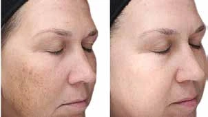 Before and After Facial Treatment - Wave Medical Aesthetics