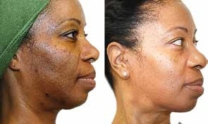 Before and after image showing significant skin improvement on the face.