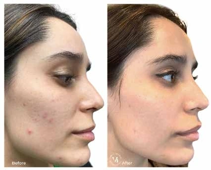 Before and After Acne Treatment - Wave Medical Aesthetics