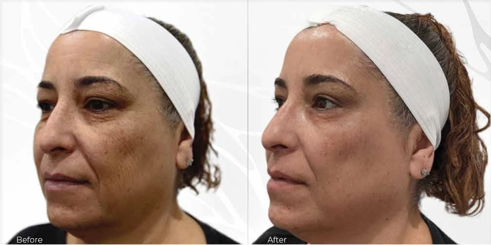 Before and after photos of a facial treatment at Wave Medical Aesthetics showing visible skin improvements